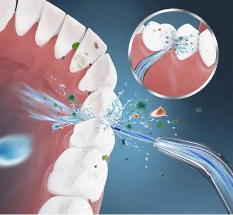 水牙线冲牙器推荐吗,冲牙器牙线哪个好用