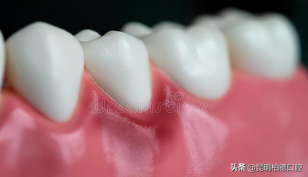 烤瓷冠牙龈变黑,全瓷冠边缘发黑怎么回事