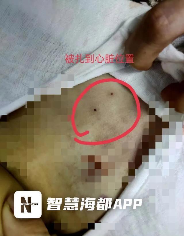 女婴被钢针刺穿心脏后救活了吗,厦门心脏穿刺儿童身亡