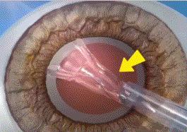 白内障最新晶体技术,白内障手术的晶体能矫正近视吗
