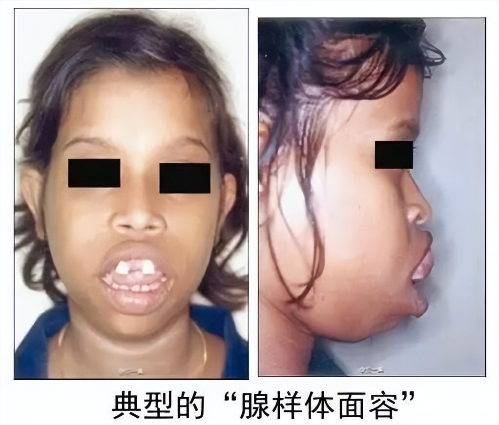 腺样体肥大除了手术还有什么办法,腺样体肥大除了切除还能怎么治