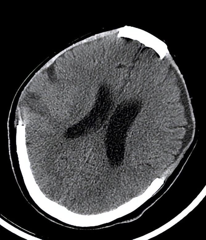 医院成功救治重型颅脑患者,特重型颅脑损伤治愈案