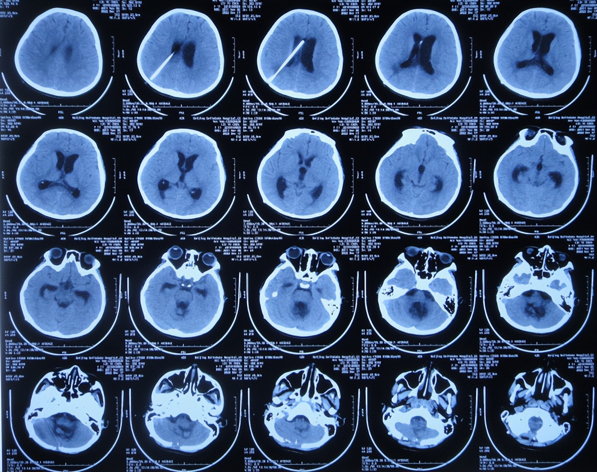 脑干出血儿童,儿童脑干胶质瘤呕吐