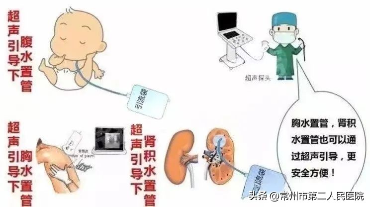 小针孔，用途多，漫画带你了解介入超声能做啥？