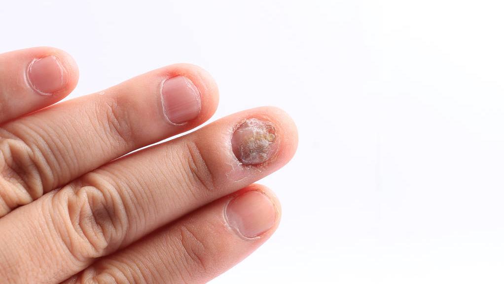 灰指甲用红霉素药膏真的好吗,红霉素治灰指甲有效吗