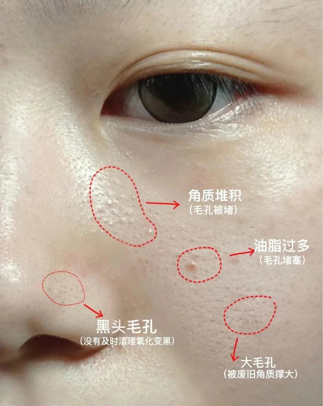 几款解决毛孔粗大的实用方法,毛孔粗大最全攻略解决办法