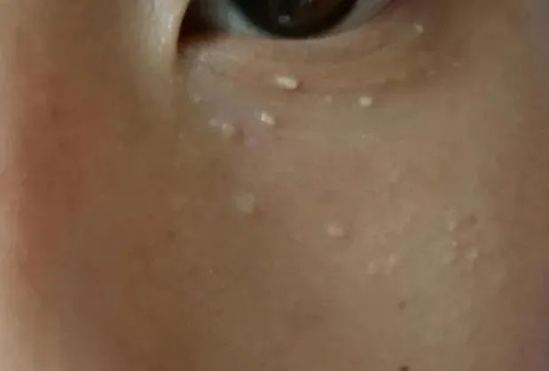 舒善：如何快速区分脸上的白色小疙瘩？