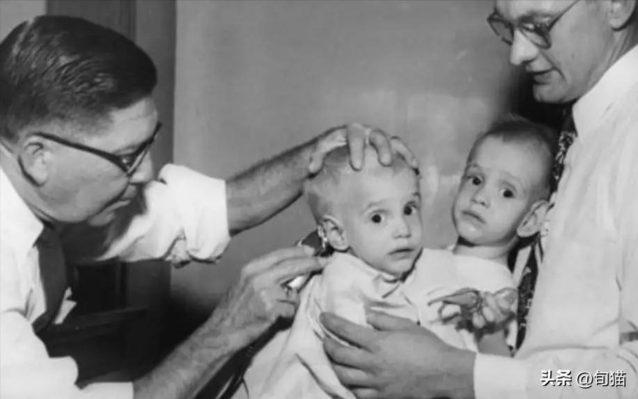 连体姐姐死亡原因,姐妹连体手术分离姐姐去世