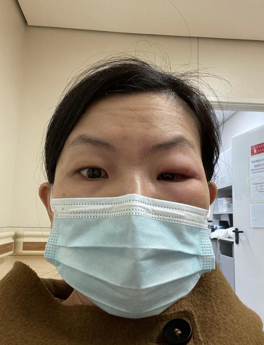 终于找到正确的医生治疗我的眼眶蜂窝织炎：详细记录住院康复经历