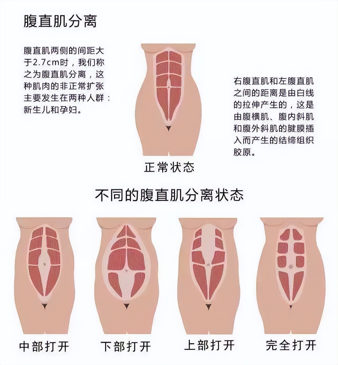 妇幼保健院有腹直肌分离修复吗,市妇幼腹直肌分离修复