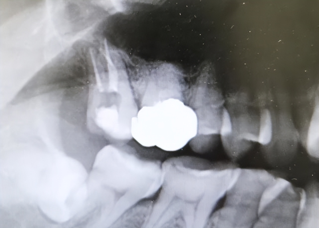 牙齿酸痛的原因是什么怎样治疗,牙齿吸风酸痛是什么原因引起的