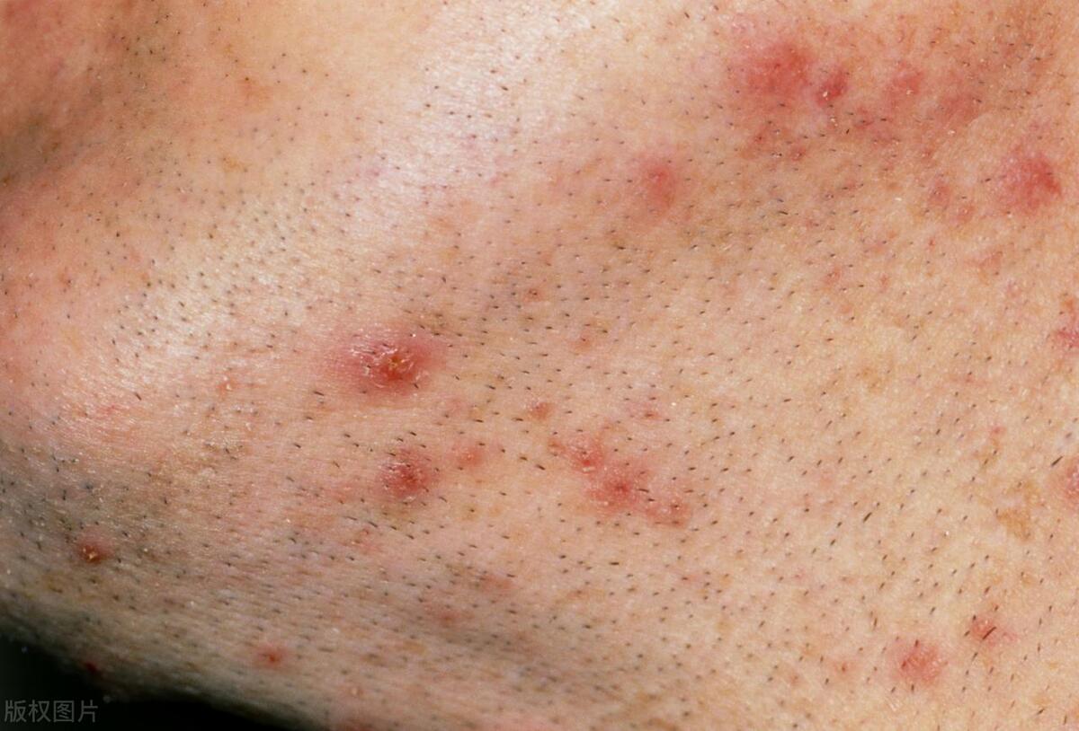 毛囊炎皮肤病是怎么引起的,皮肤病真菌毛囊炎症状