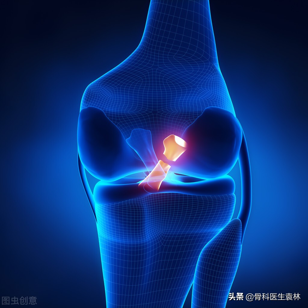 半月板部分切除还能打羽毛球么,半月板损伤切除有什么影响