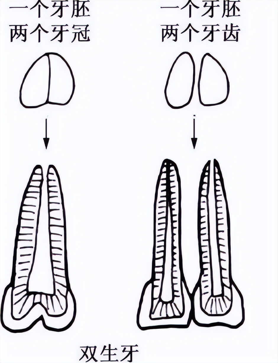 连体畸形牙齿,牙齿有重叠部分可以把牙齿磨小吗