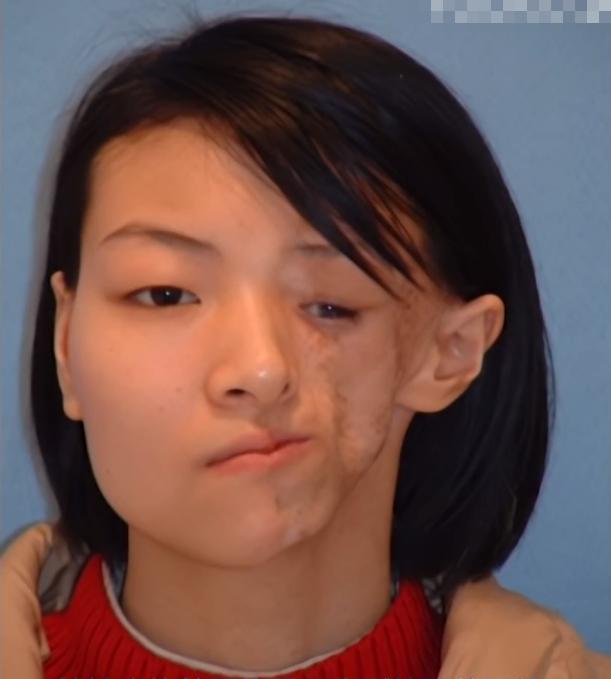 二十岁花季少女毁容手术,重庆15岁花季少女被毁容之后