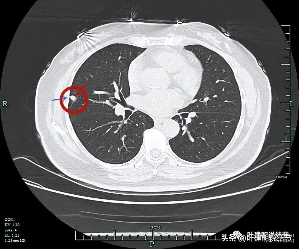 子宫内膜癌术后病灶大于二厘米,子宫内膜癌手术后一年又发现肺癌