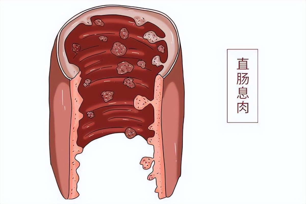 肠息肉切除后怎么避免再长,肠息肉切除后再长出来怎么办