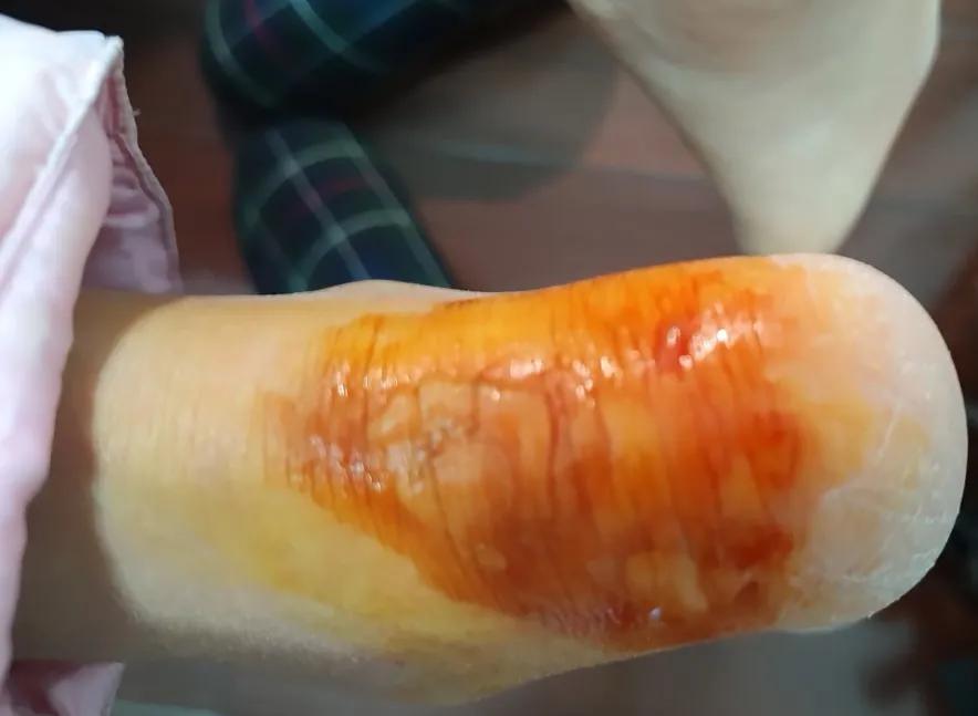 脚后跟红肿皮干,脚后跟红肿用什么药治疗