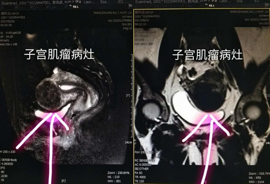 女性没了子宫，会影响“行事”？医生坦言：满意度反而提高了