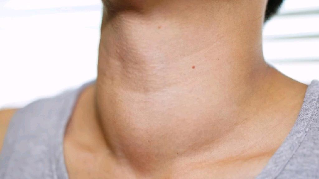 蒲公英能杀死癌细胞是真的吗,蒲公英杀死癌细胞治疗甲状腺结节