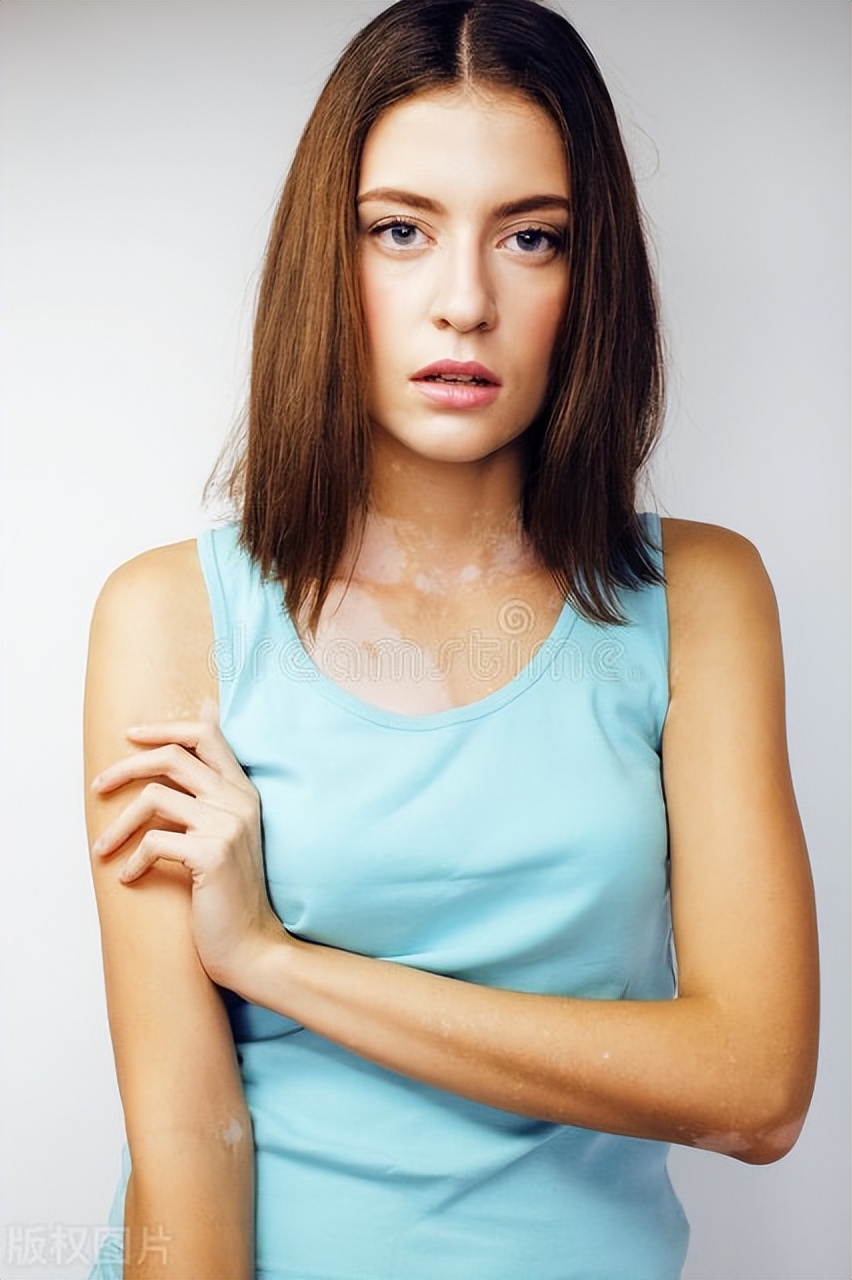 得了白癜风对寿命有影响吗,得了白癜风会对生活有什么影响