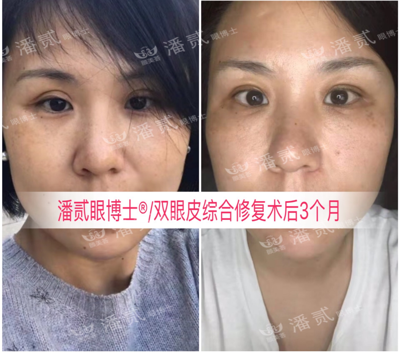 东莞整形做双眼皮,东莞整形医院割双眼皮