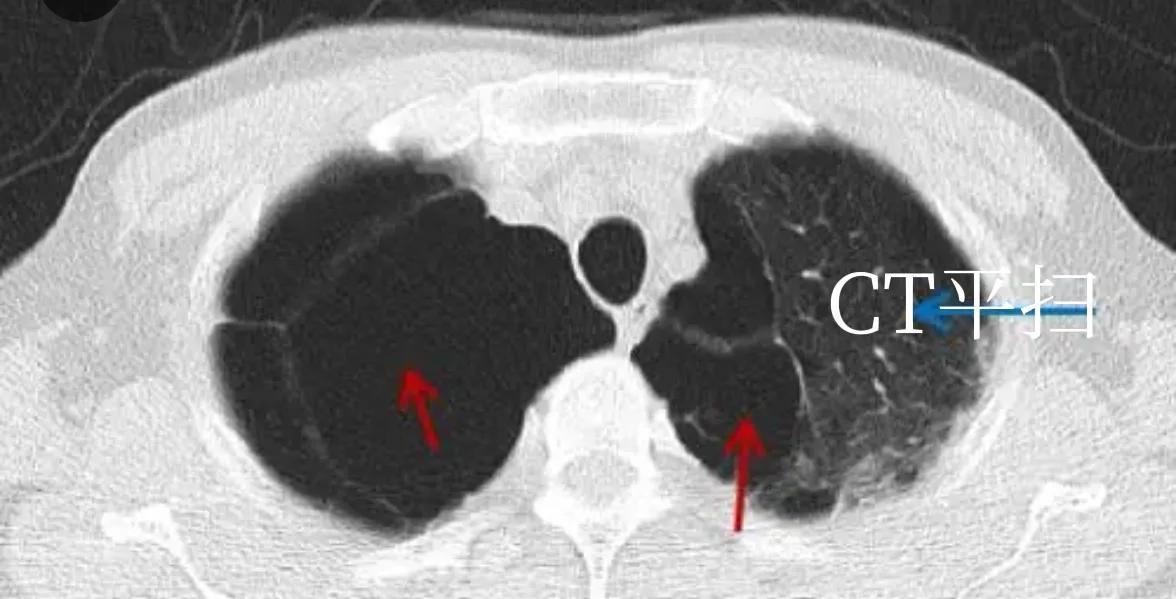 肺大泡产生的原因及治疗方案,肺大泡怎么治疗断根