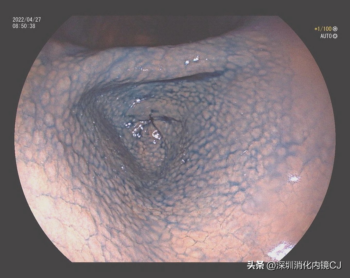 幽门螺旋杆菌感染胃粘膜表现,没有幽门杆菌但是胃窦鸡皮样改变