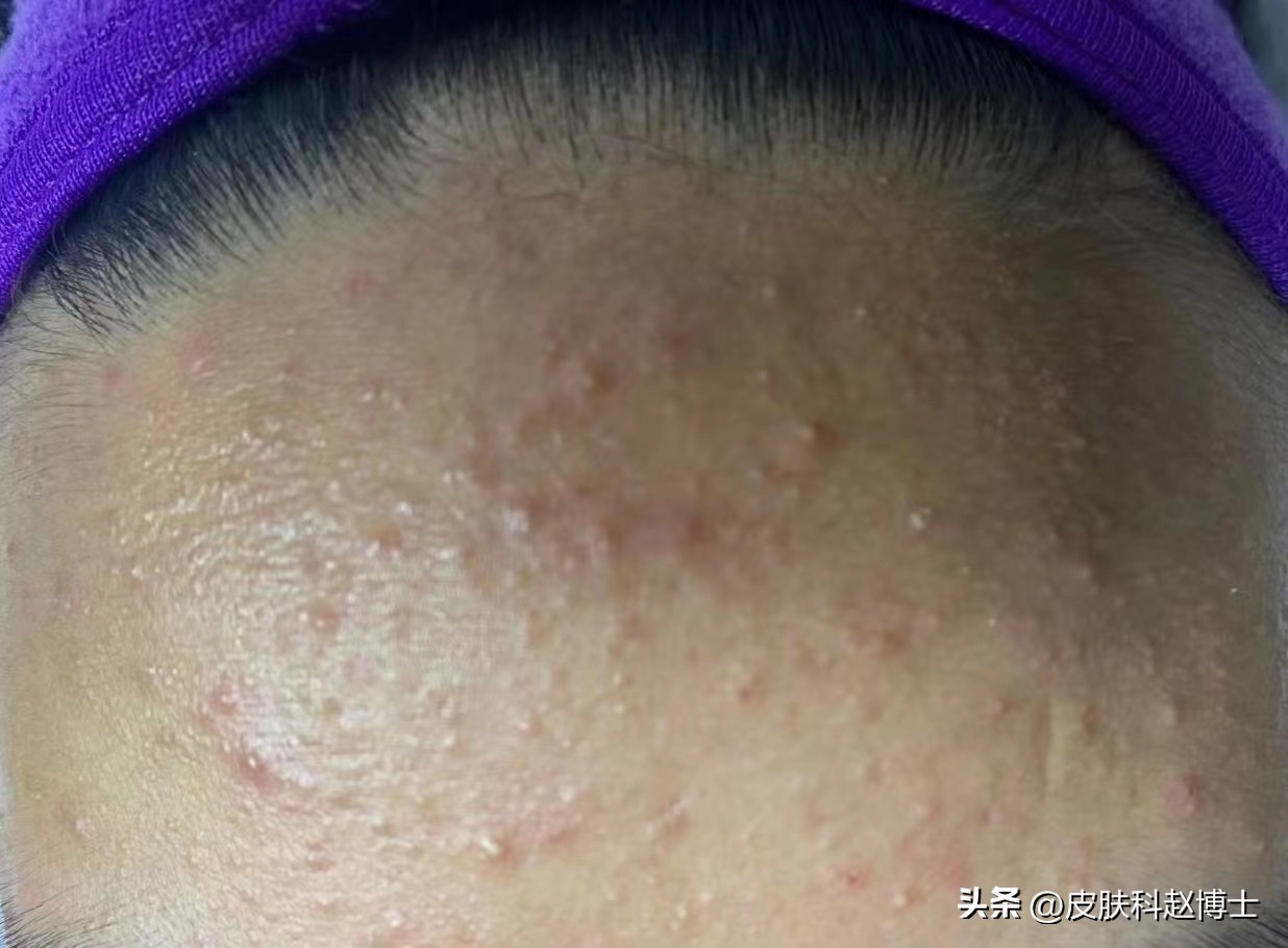 小孩脸上黑头怎么处理,脸上反反复复长黑头粉刺