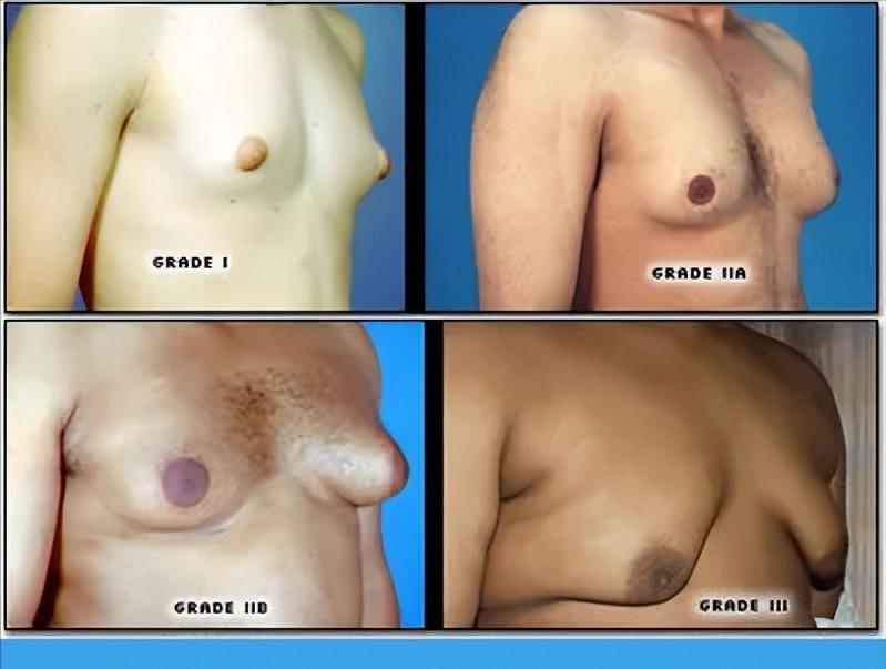 男生胸部太大的原因,男生的胸部大的原因