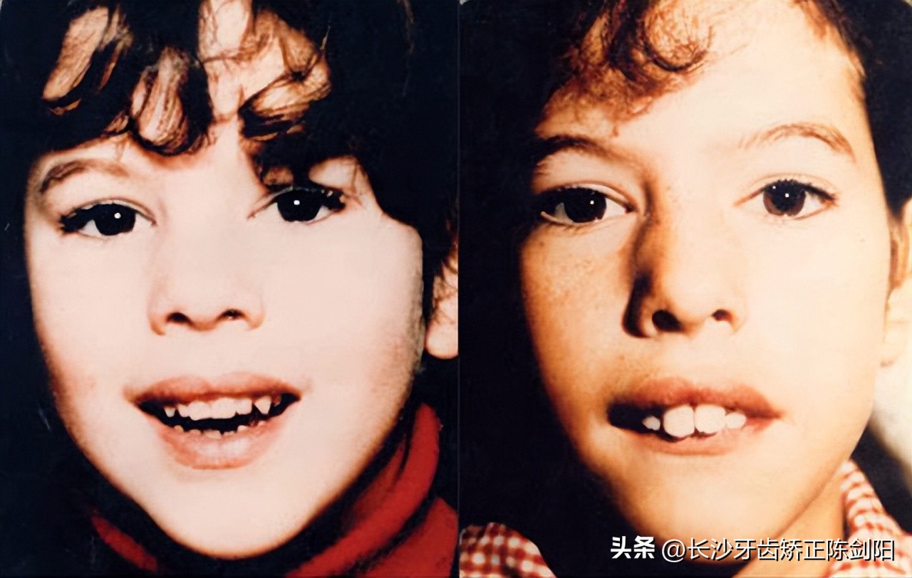 张嘴呼吸怎么自然改善,睡觉张嘴呼吸会变丑的图片