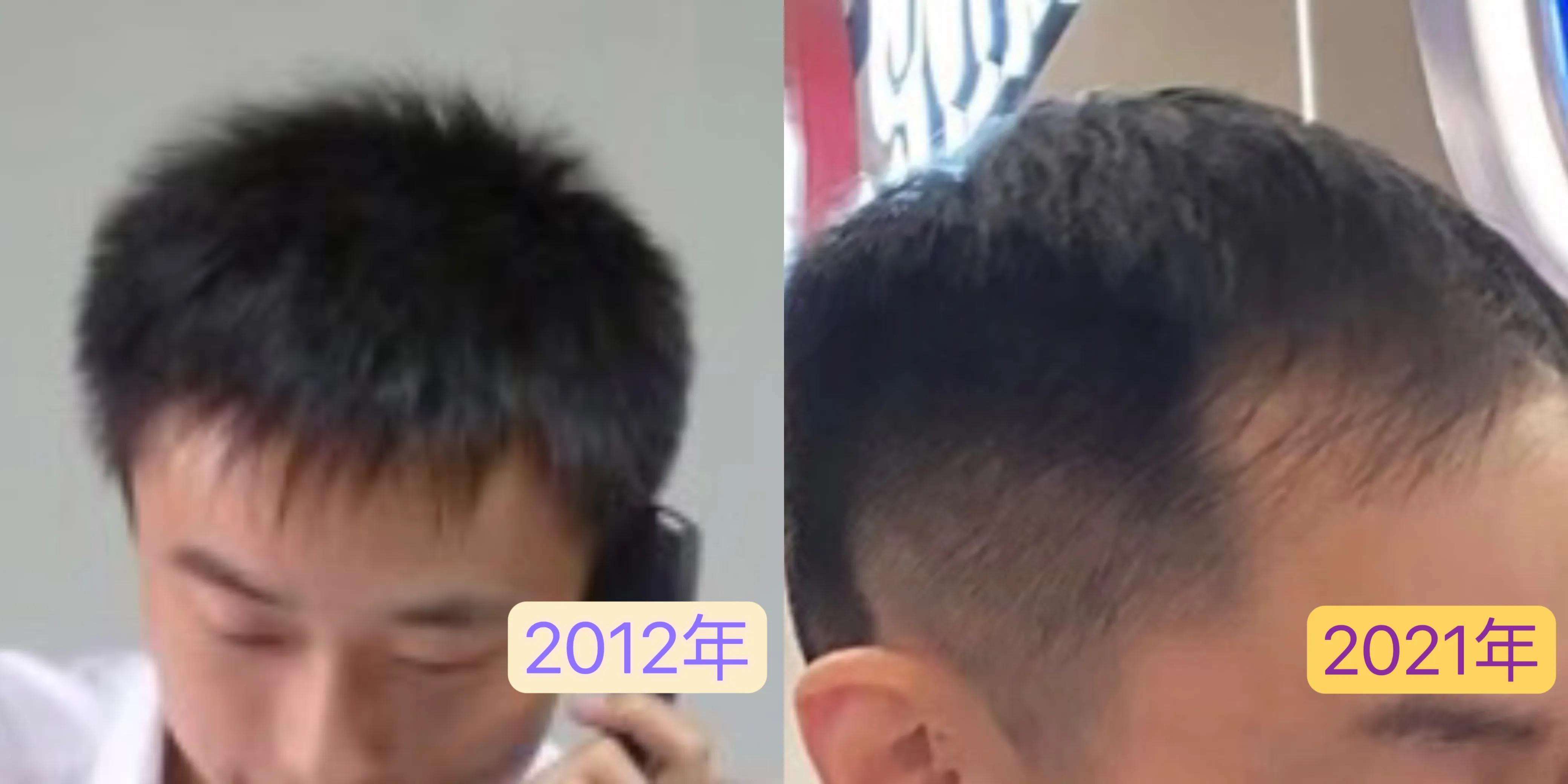 花费四万元植发一年后效果仍不明,男生大面积植发八个月真实效果