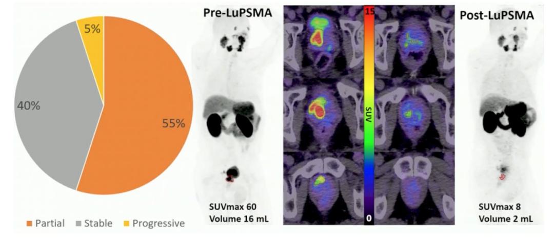 psma治疗前列腺癌,psma放射配体疗法