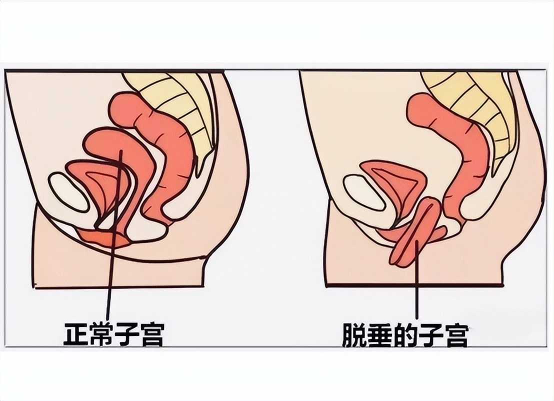 阴挺是什么症状表现,引起阴挺的病因有哪些