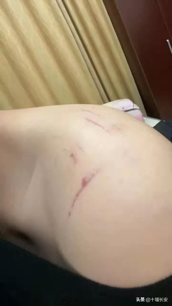 民警背着伤员爬山身上多处受伤,爬山崴脚消防员