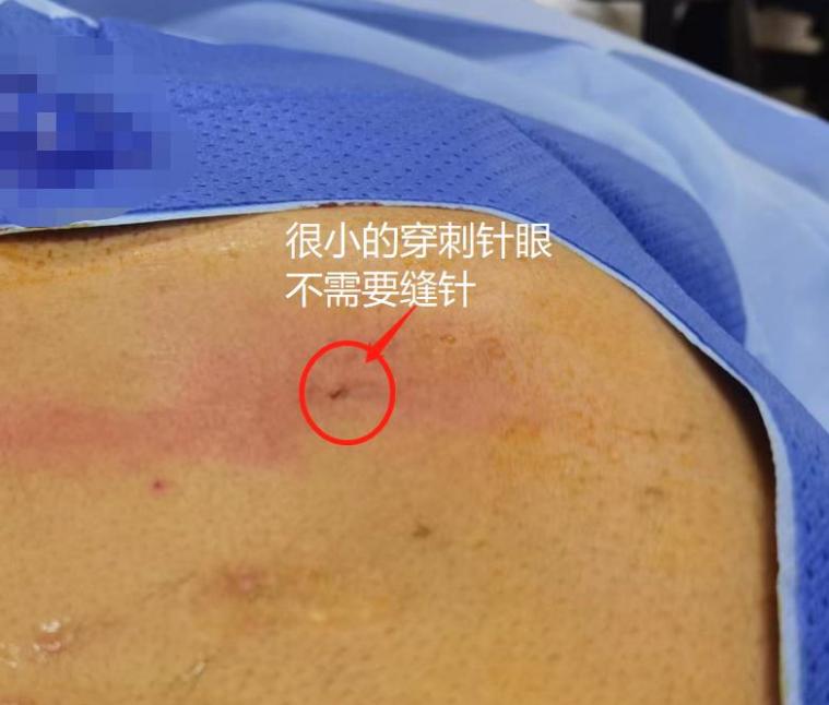 什么肝癌适合射频消融治疗,射频消融治疗肝癌适应症