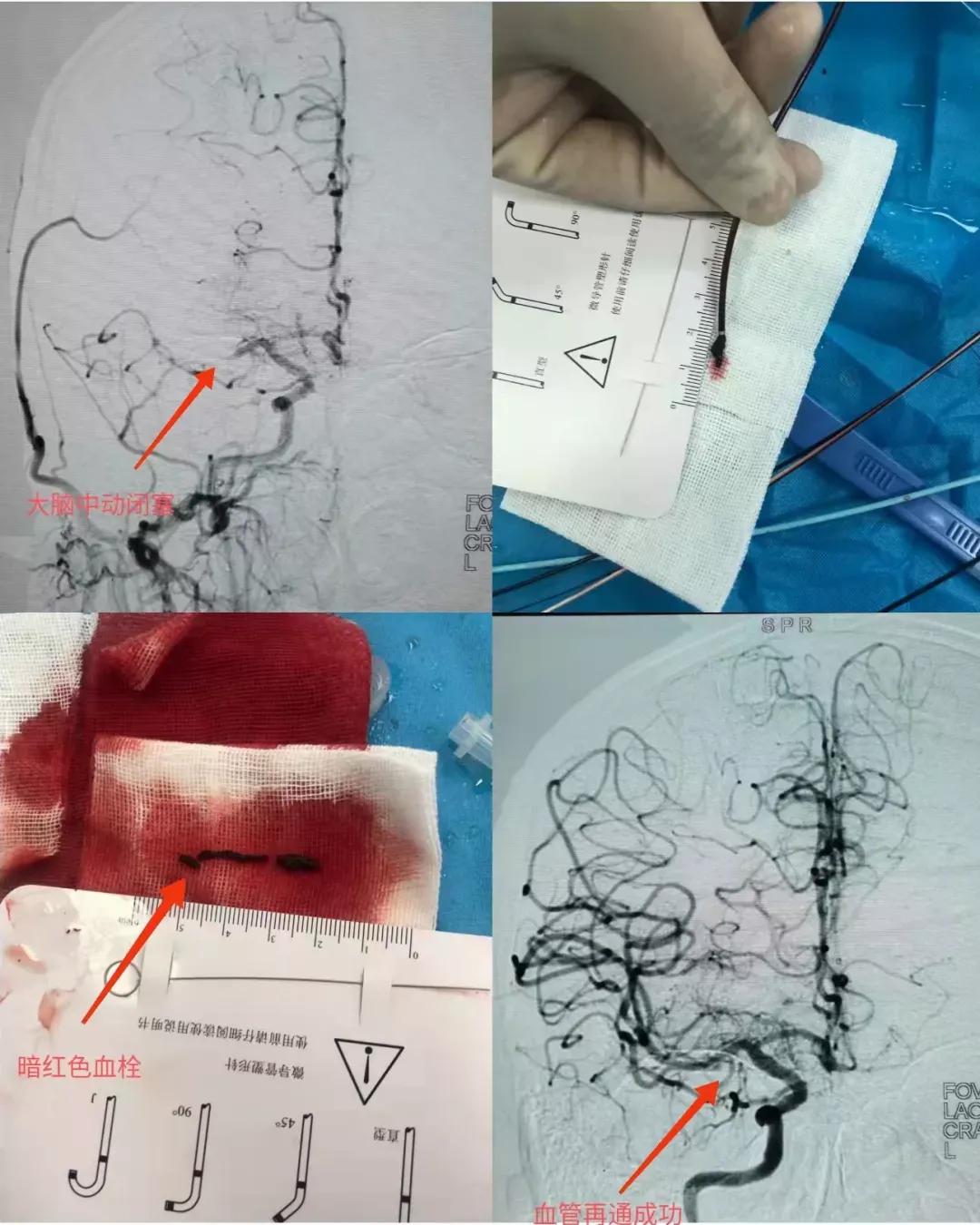 溶栓取栓争分夺秒,争分夺秒抢救脑梗