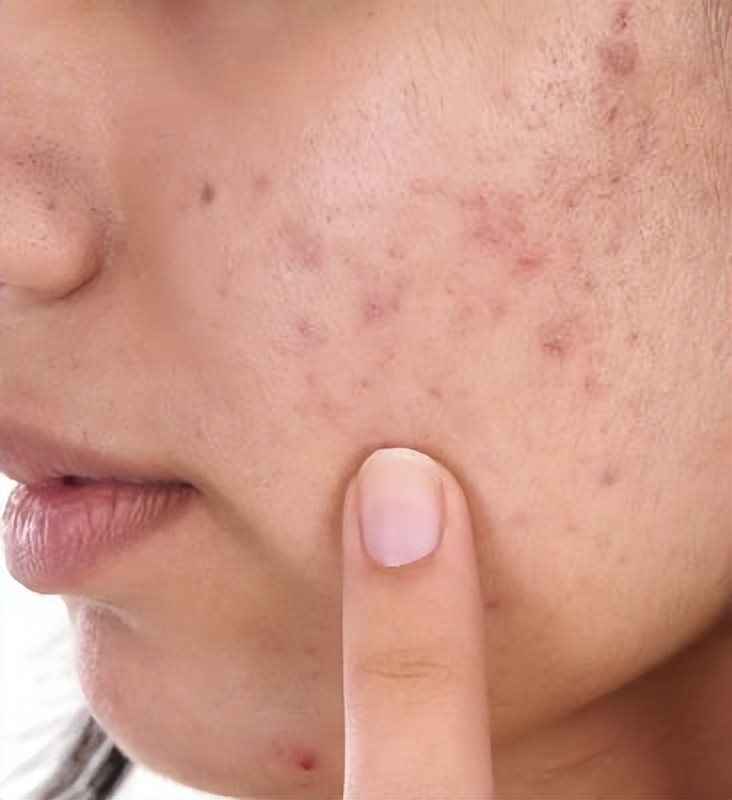 青春痘太多想消除,青春期长痘后毛孔变大怎么修复