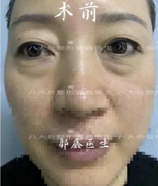 56岁做眼袋手术,眼袋手术的真实感受