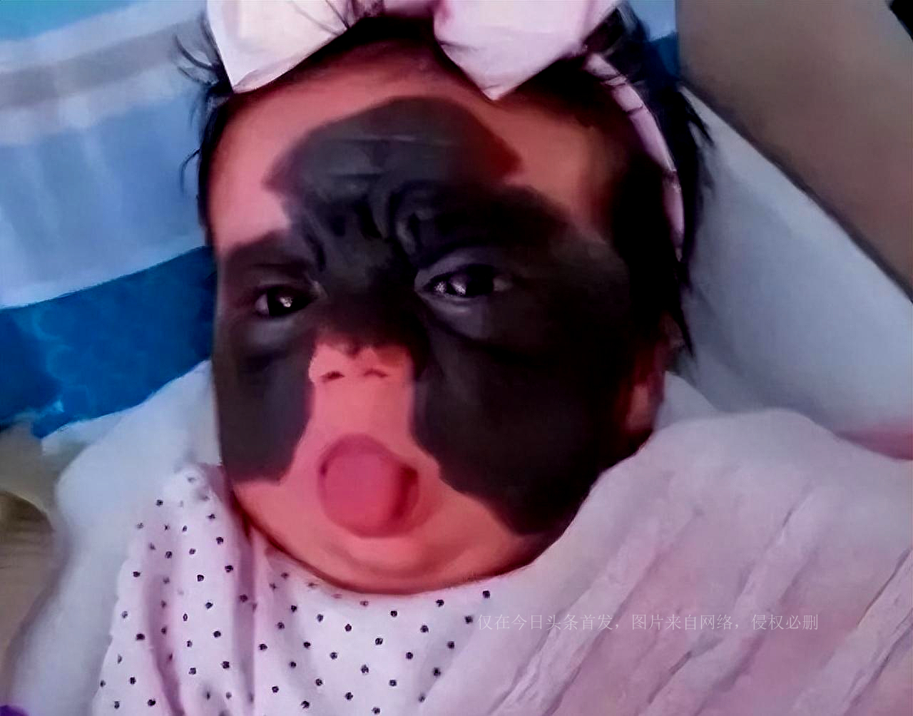 还记得天生胎记酷似“蝙蝠侠”的女婴吗？6次整容后，仍需治疗