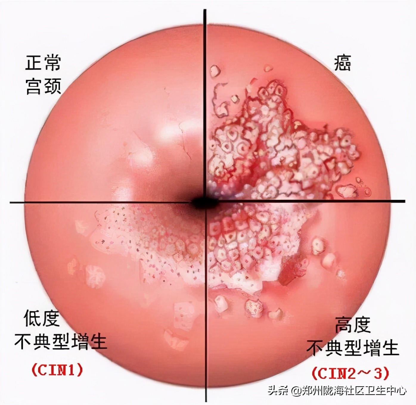 宫颈筛查报告怎么看,宫颈筛查的报告单怎么看