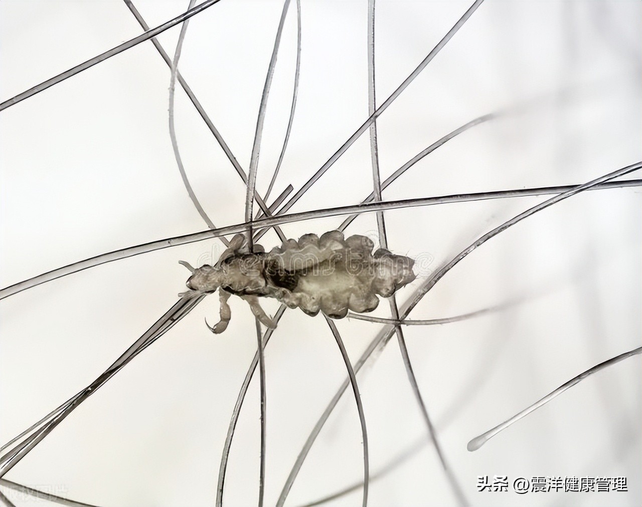 阴虱是什么原因发生的,阴虱是什么为什么会得阴虱