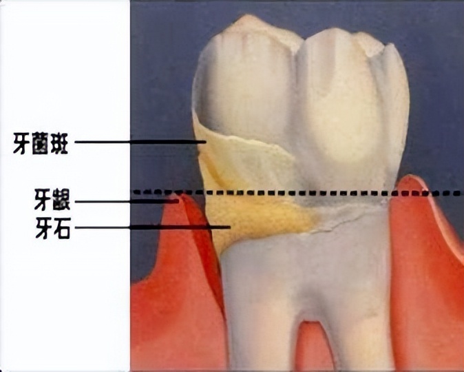 牙缝里的牙结石，如何清除干净？医生：2个办法是不少人的选择