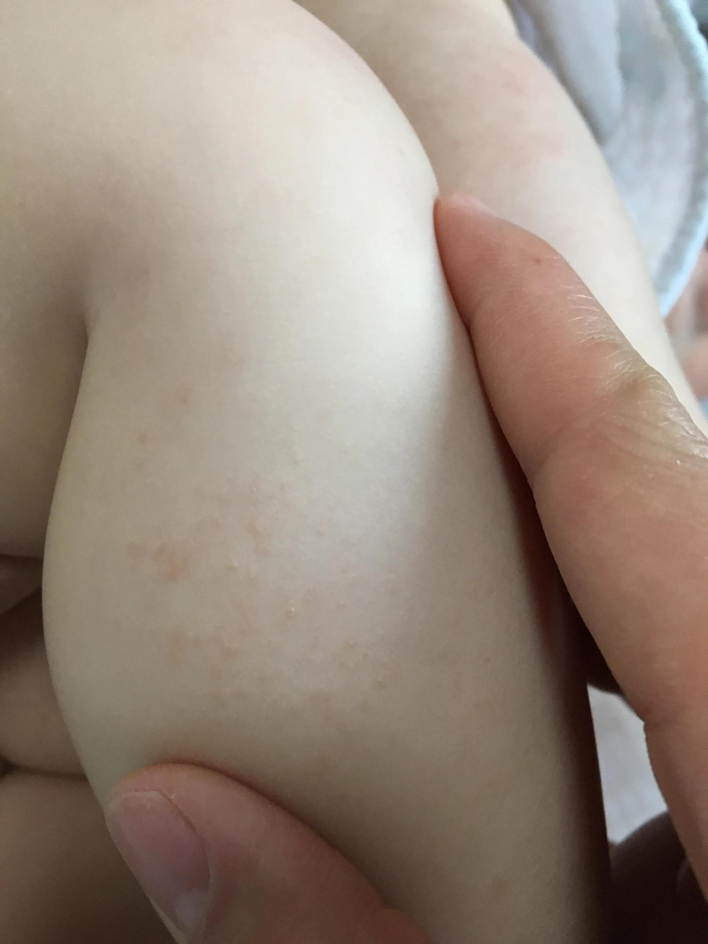 宝宝湿疹大作战,宝宝湿疹反复妈妈需要忌口什么