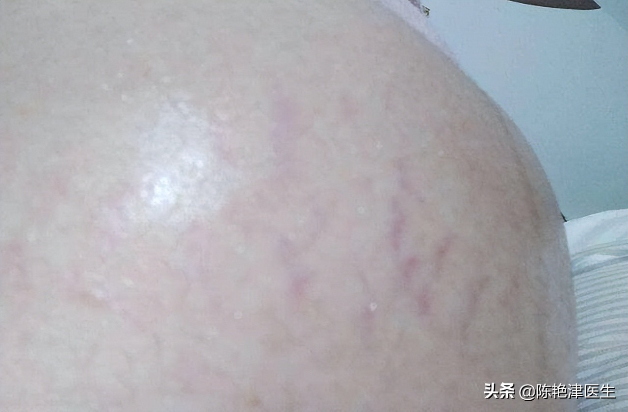 年轻妈妈妊娠纹严重的肚子照片,13岁女孩肚子爬满妊娠纹吓到妈妈