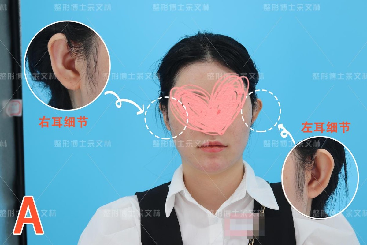 耳软骨隆鼻会塌下来吗,软骨隆鼻鼻小柱会塌吗