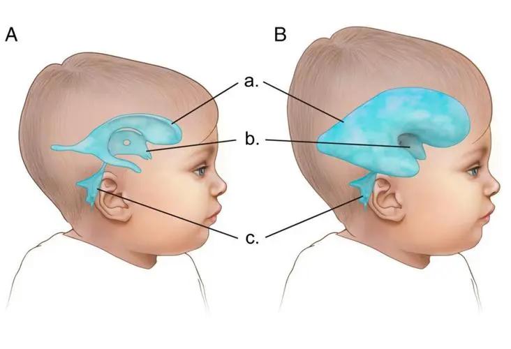 先天性脑积水能坚持多久,成人先天脑积水有必要治疗吗