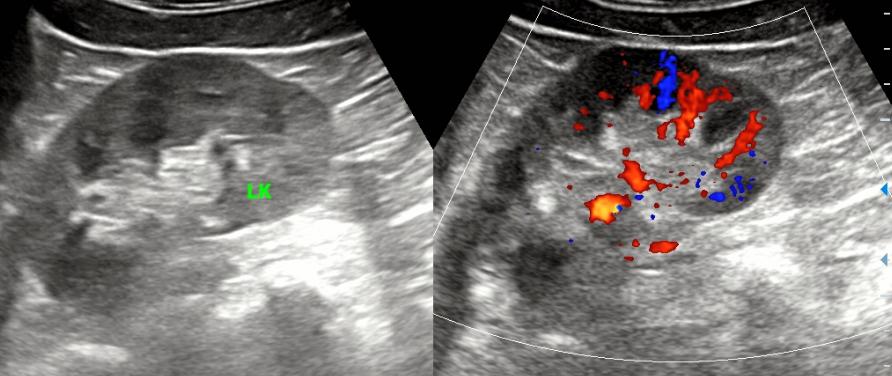 超声所见正常范围准确吗,超声看不清楚