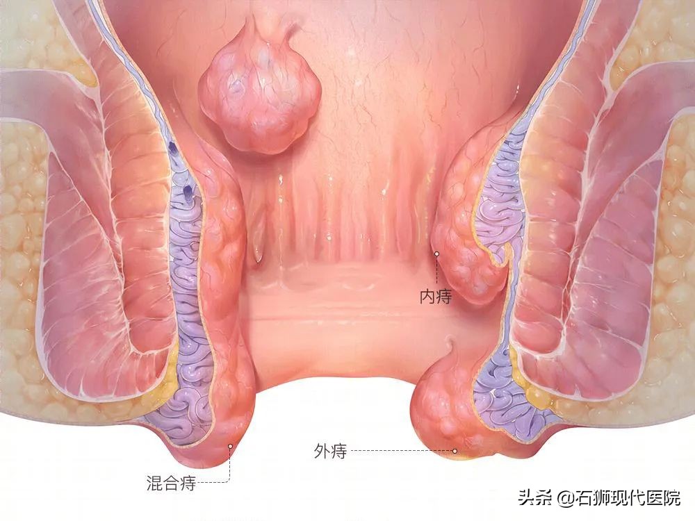 轻微外痔疮肉球能自愈吗,便秘导致的痔疮会自愈吗