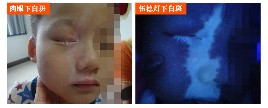 儿童眼皮白癜风能自动痊愈吗,眼睛白癜风睫毛也白了能治好吗